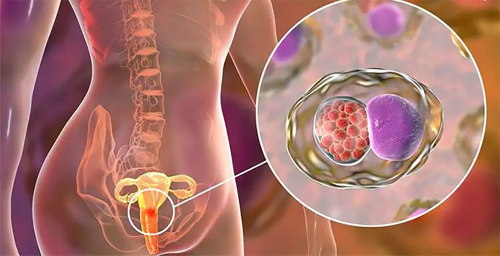 Pelvic-Inflammatory-Disease-Image-of-the-Reproductive System of a Woman1